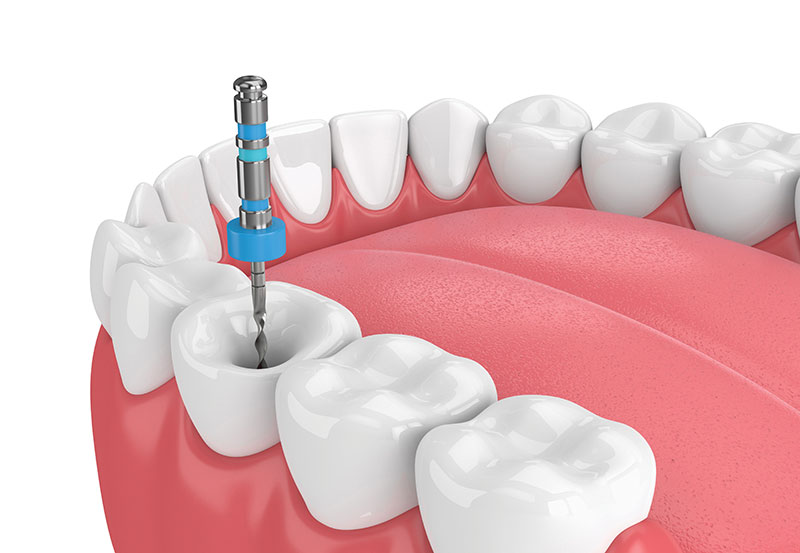 Endodonti