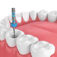 endodonti-800x553